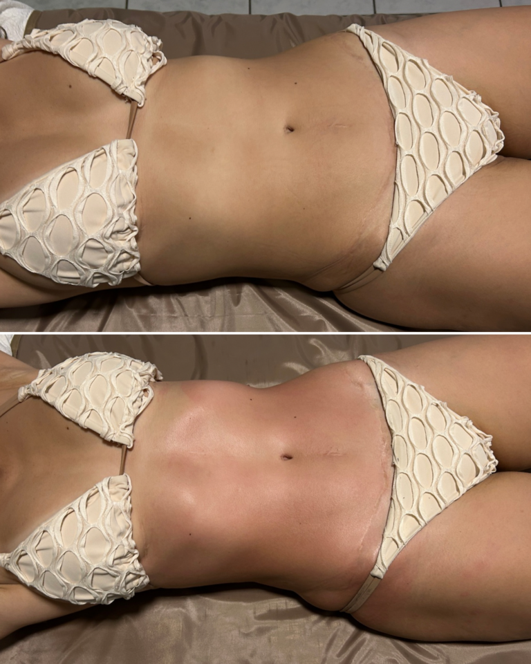 ANTES E DEPOIS JUIANA GOBBI.PNG (2)